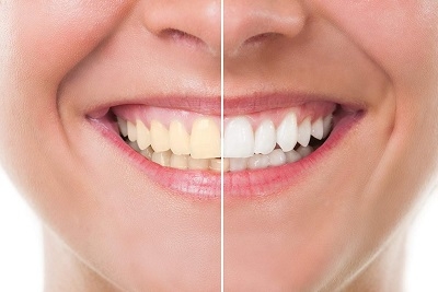 Blistavo beli zubi pomoću tretmana sa Zoom lampom po akcijskoj ceni