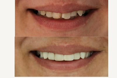  Kompozitne fasete slika 2