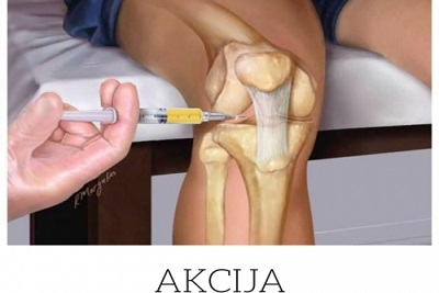  Tretman krvnom plazmom (prp) kolena 